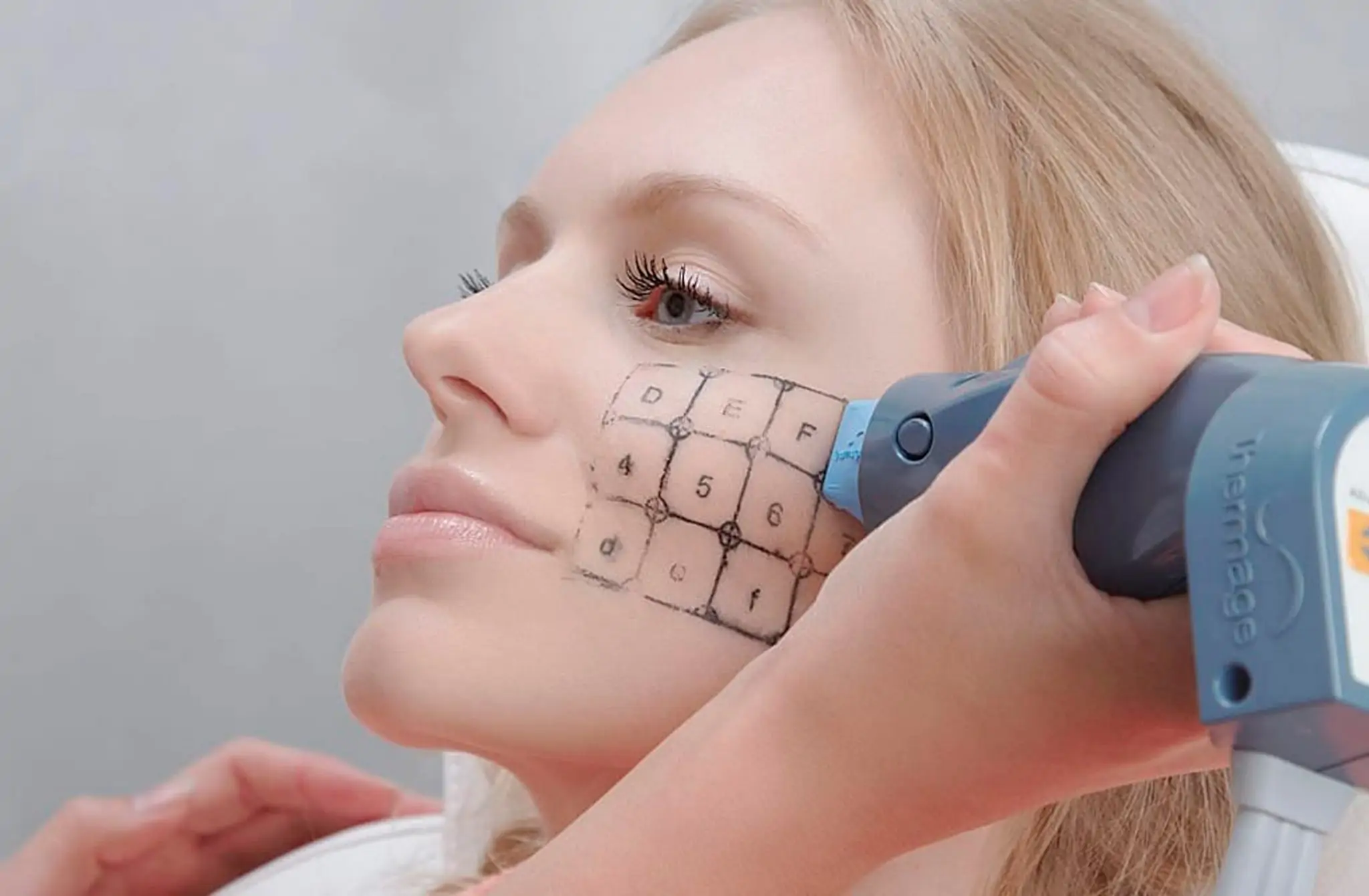 Termage - Ästhetik Lab Procedure Gallery