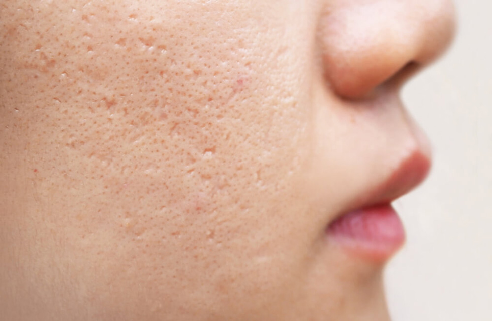 Skin regeneration - Ästhetik Lab Procedure Gallery