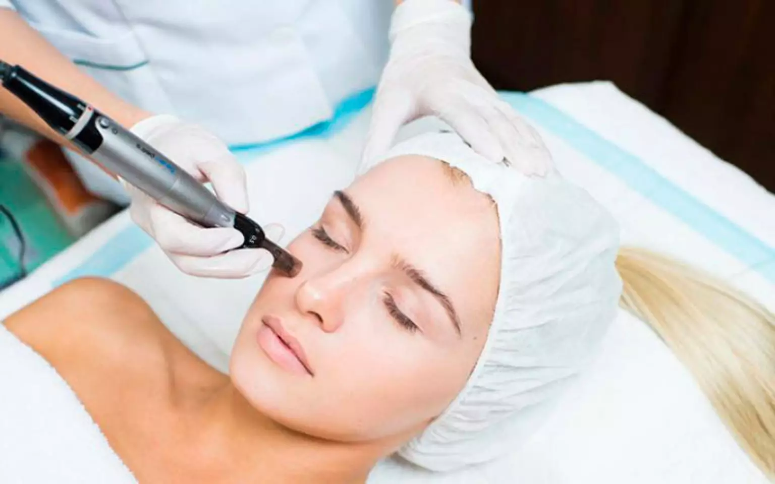 Microneedling